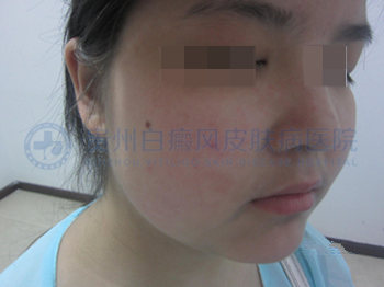 儿童面部、颈部白斑一年半