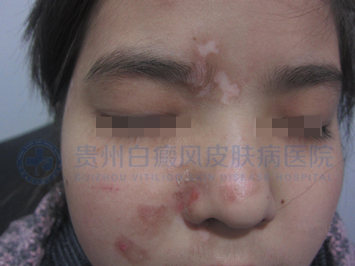 儿童面部、颈部白斑一年半