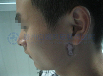 男性耳部局限型白癜风2年