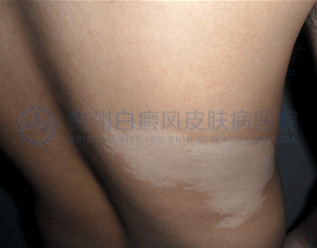 男性背部局限型白癜风5年