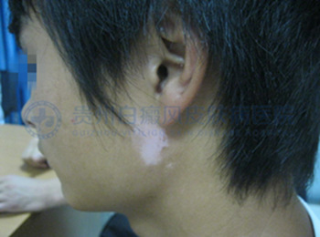 男性耳部局限型白癜风2年