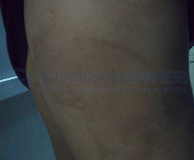 男性背部局限型白癜风5年