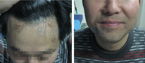 男性1年白癜风在我院3个月康复