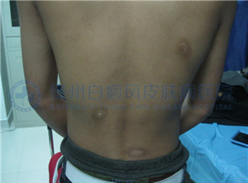 青少年背部白癜风2年