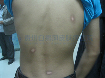 青少年背部白癜风2年
