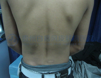 青少年背部白癜风2年