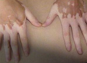 手上有白癜风要注意哪些问题