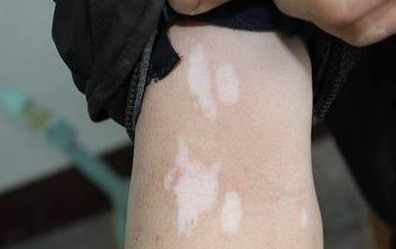 手部白癜风的危害性有多大?