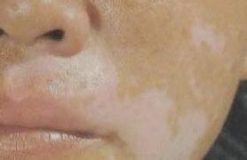 脸部白癜风能治好吗?