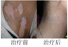 女性白癜风治疗起来什么方法副作用小
