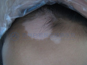 面部白癜风能治愈吗?