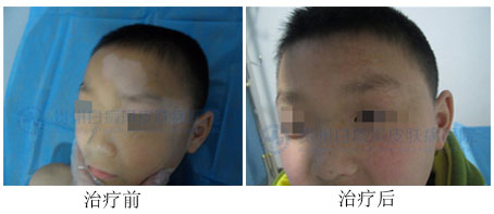 面部白癜风的发病原因是什么