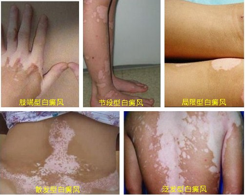 胸部白斑是不是白癜风