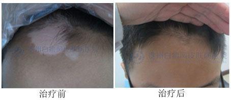 面部白癜风能治愈吗?