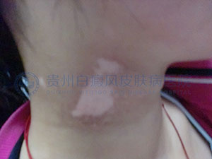 导致颈部白癜风的病因有哪些