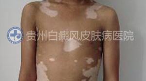 胸部白癜风要如何诊断