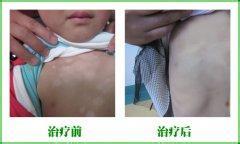 引发胸部白癜风的原因有哪些