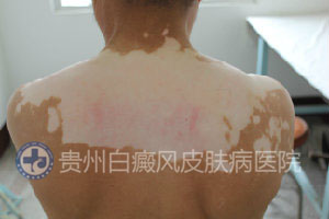 背部白斑病的症状是什么