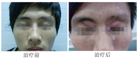 面部白癜风的护理知识是什么