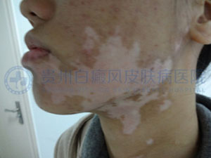 怎么来判断面部白癜风的症状呢?
