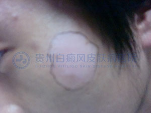 专家提醒:面部白癜风的治疗慎用外用药