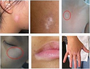 白癜风有哪些自我诊断的方法?