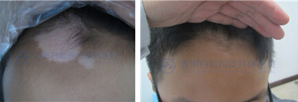 白癜风能治好吗?