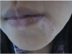 白癜风会传染吗?