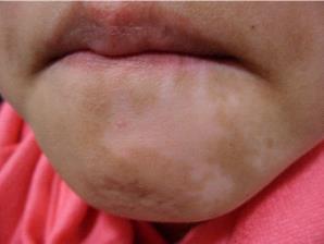 脸上长白斑是白癜风怎么办?