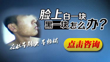 脸部出现白癜风症状该怎么办